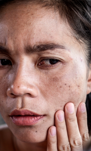 in blog photo-22 Protect Your Skin with IV Therapy